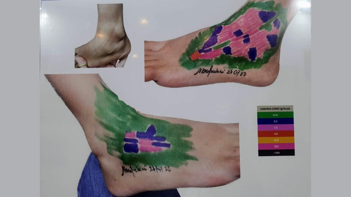 Médico cria exposição artística com fotografias de manchas na pele por hanseníase