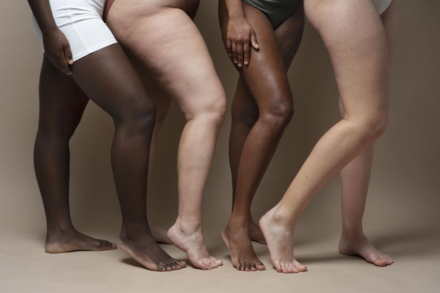 CALOR PROVOCA PROBLEMAS PARA QUEM TEM LIPEDEMA E REQUER CUIDADOS COM SAÚDE VASCULAR