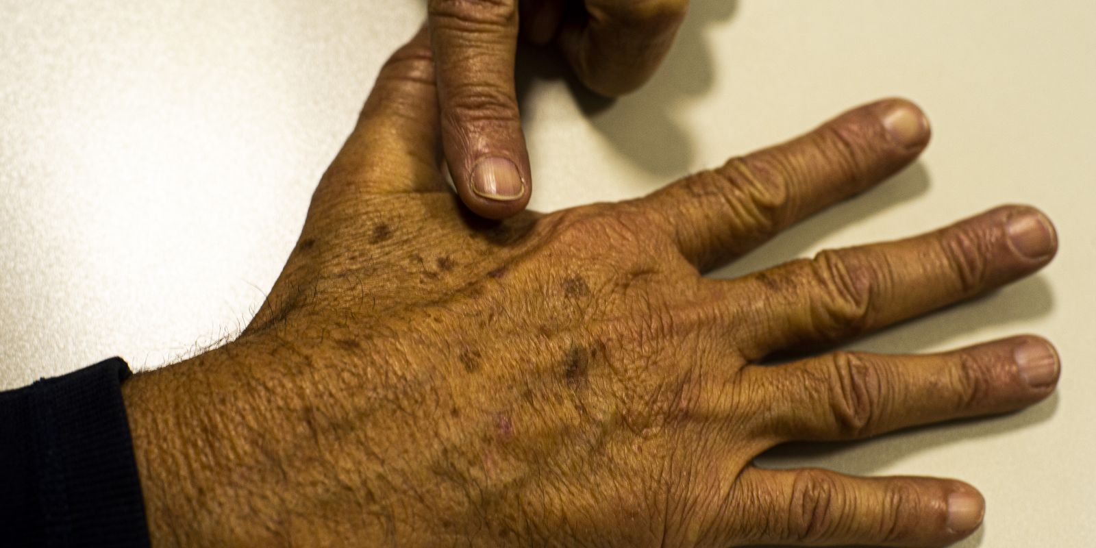 Falta de dados sobre câncer de pele prejudica identificação da doença, alerta fundação