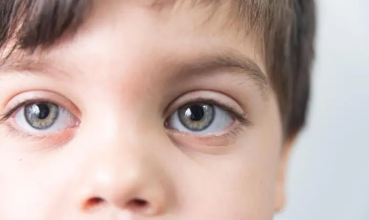 CÂNCER OCULAR INFANTIL CAUSA “OLHOS DE GATO” E PODE PROVOCAR CEGUEIRA